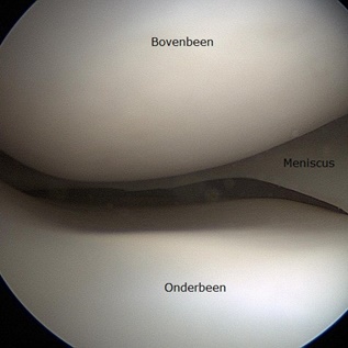 foto scopie meniscus
